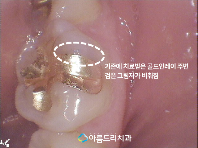 치아우식증 어금니충치 재충치치료 관련 이미지 4