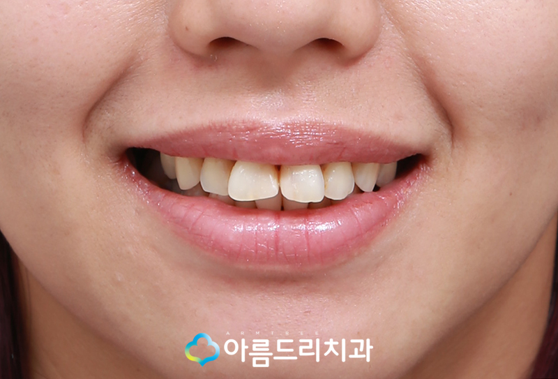 라미네이트연예인 이빨(치아) 최소삭제 이거다 관련 이미지 3