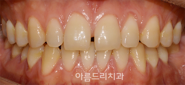 벌어진앞니부분교정 짧은기간 치아교정 관련 이미지 3