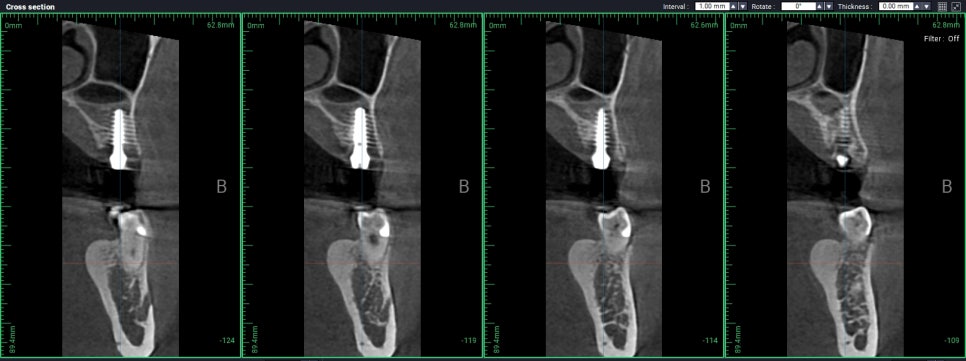 무절개 무봉합 상악동 거상술 관련 이미지 3