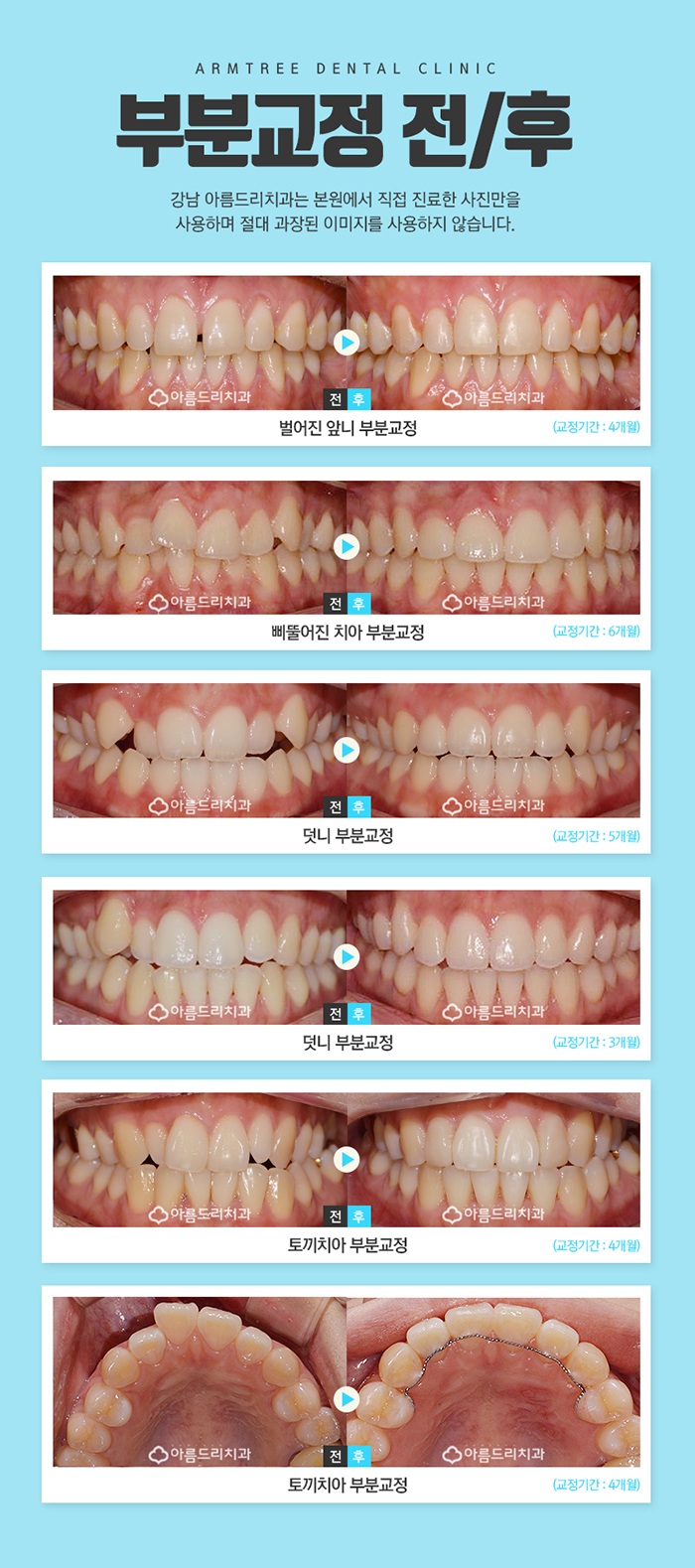 토끼앞니교정 앞니덧니 정답은? 관련 이미지 7