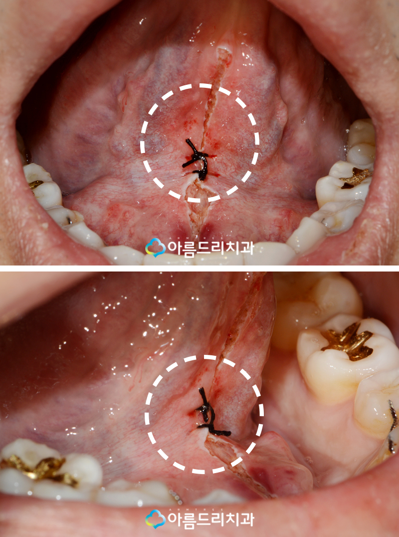 성인 설소대 수술 시술 완벽하게 관련 이미지 9