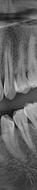반포치과 사랑니발치 치과를 찾고있다면 관련 이미지 10