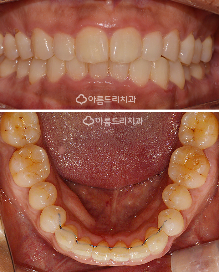 아랫니부분교정 가격 후기 정보후기 관련 이미지 7