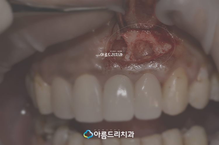 치근단절제술 후기로보는 완벽함 관련 이미지 7
