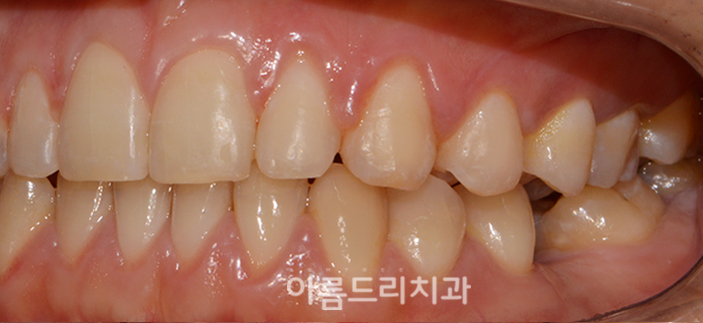 벌어진앞니부분교정 짧은기간 치아교정 관련 이미지 10