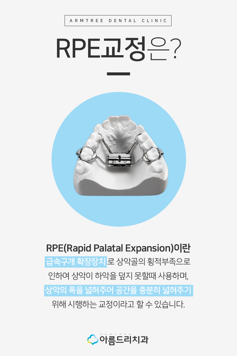 어린이 부정교합교정 RPE 악궁확장장치 관련 이미지 3
