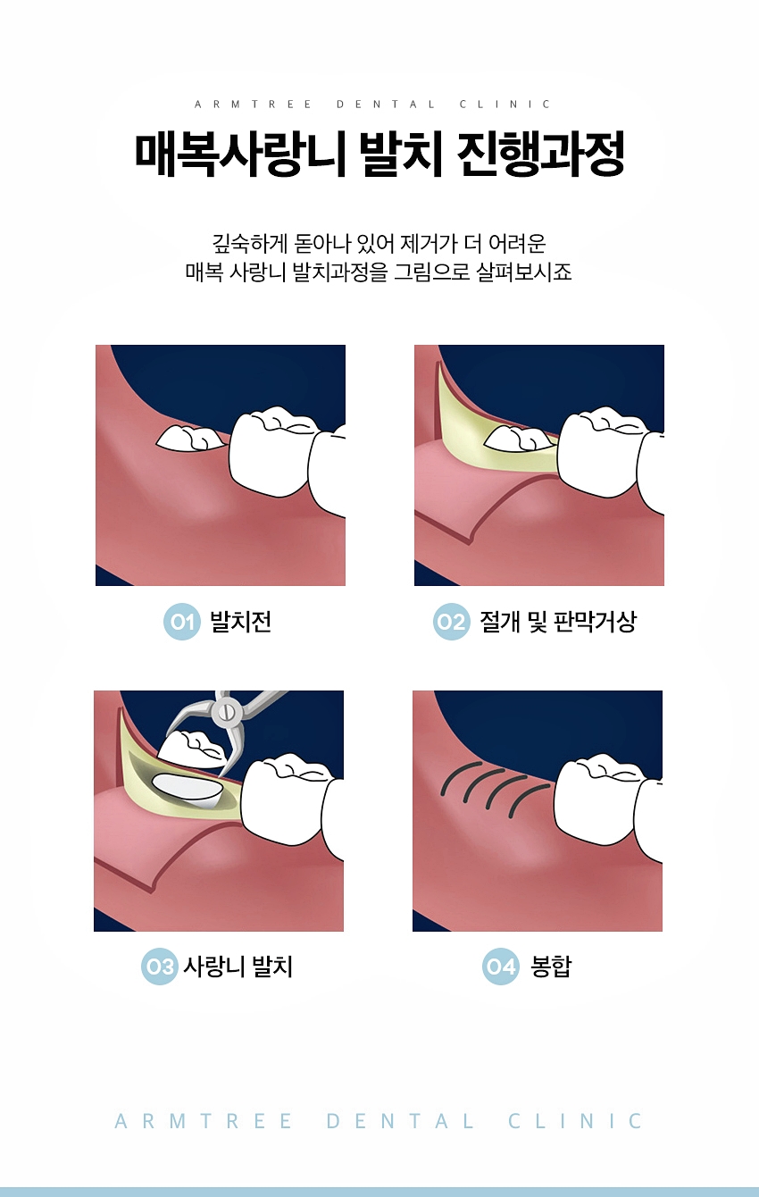 매복사랑니발치 통증없는 아름드리치과 관련 이미지 4