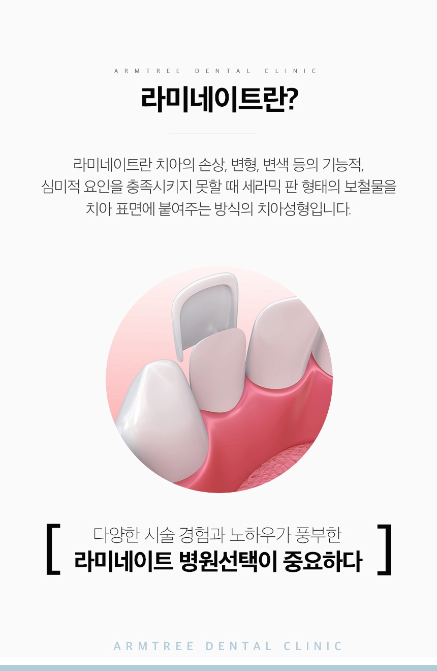 연예인라미네이트 신중하게 확인사항을 관련 이미지 3