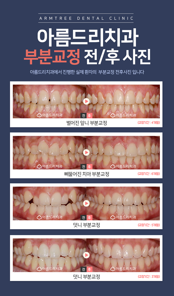 돌출앞니부분교정 제대로 알자 관련 이미지 5
