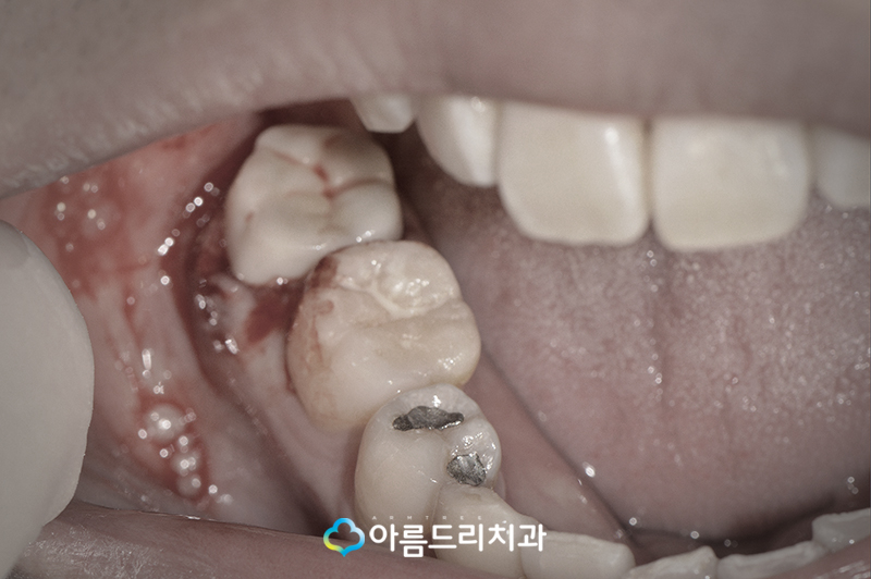 치아재식술 후기 자연치아지키기 관련 이미지 9