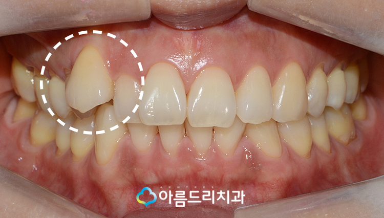 설측교정 후기앞니 단기간에 관련 이미지 3