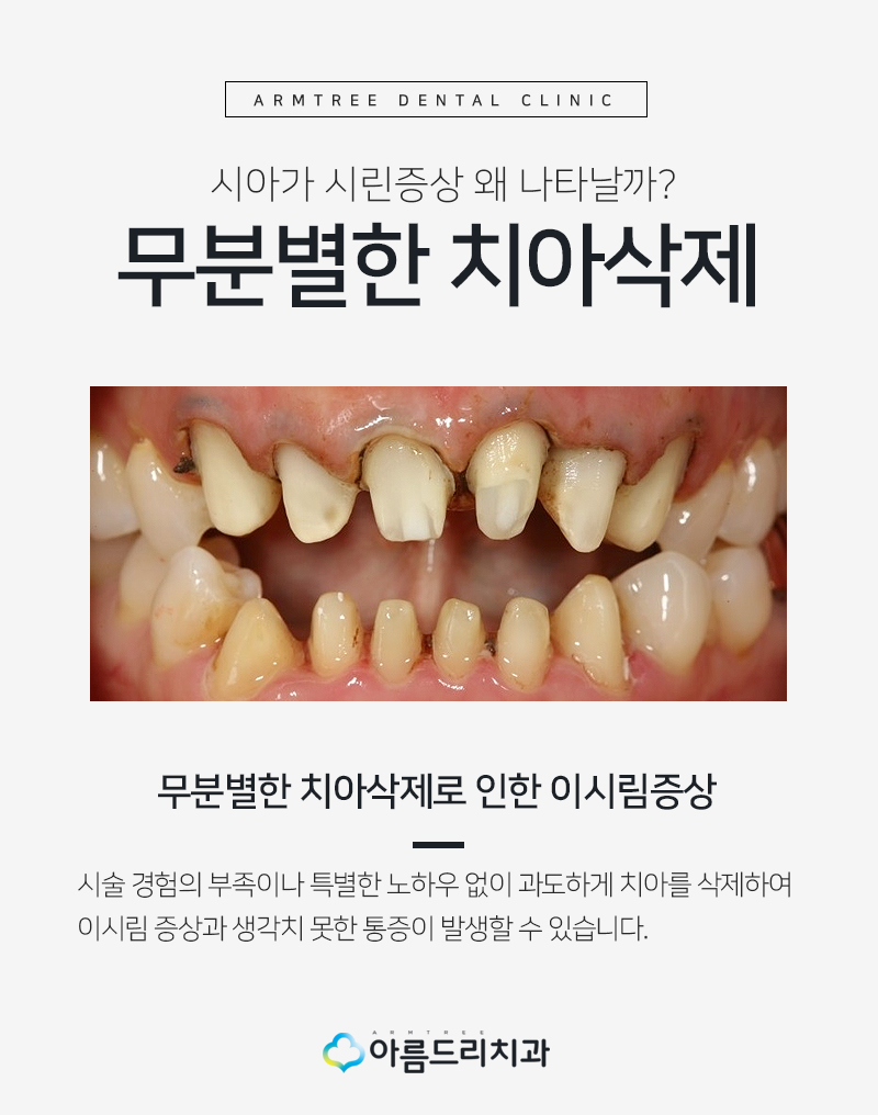 치아라미네이트 삭제량이 초중요 관련 이미지 5
