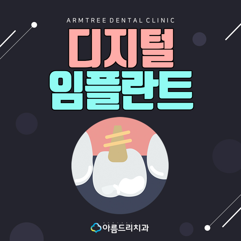 네비게이션 인플란트 기간은 어떻게? 관련 이미지 1