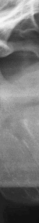 신논현역치과 사랑니 발치를 원한다면 관련 이미지 5