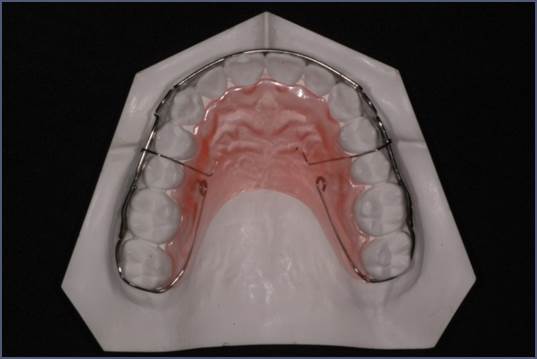 교정 완료_유지 장치 어떤 거 해야 해? 관련 이미지 4