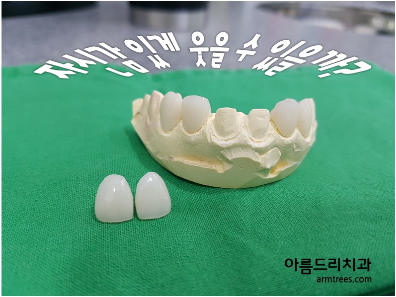 앞니 변색 _ 블랙 트라이앵글 #올 세라믹 관련 이미지 6