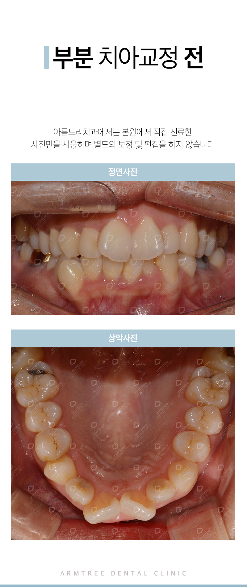 앞니부분교정 꼼꼼하고 예리하게 관련 이미지 3
