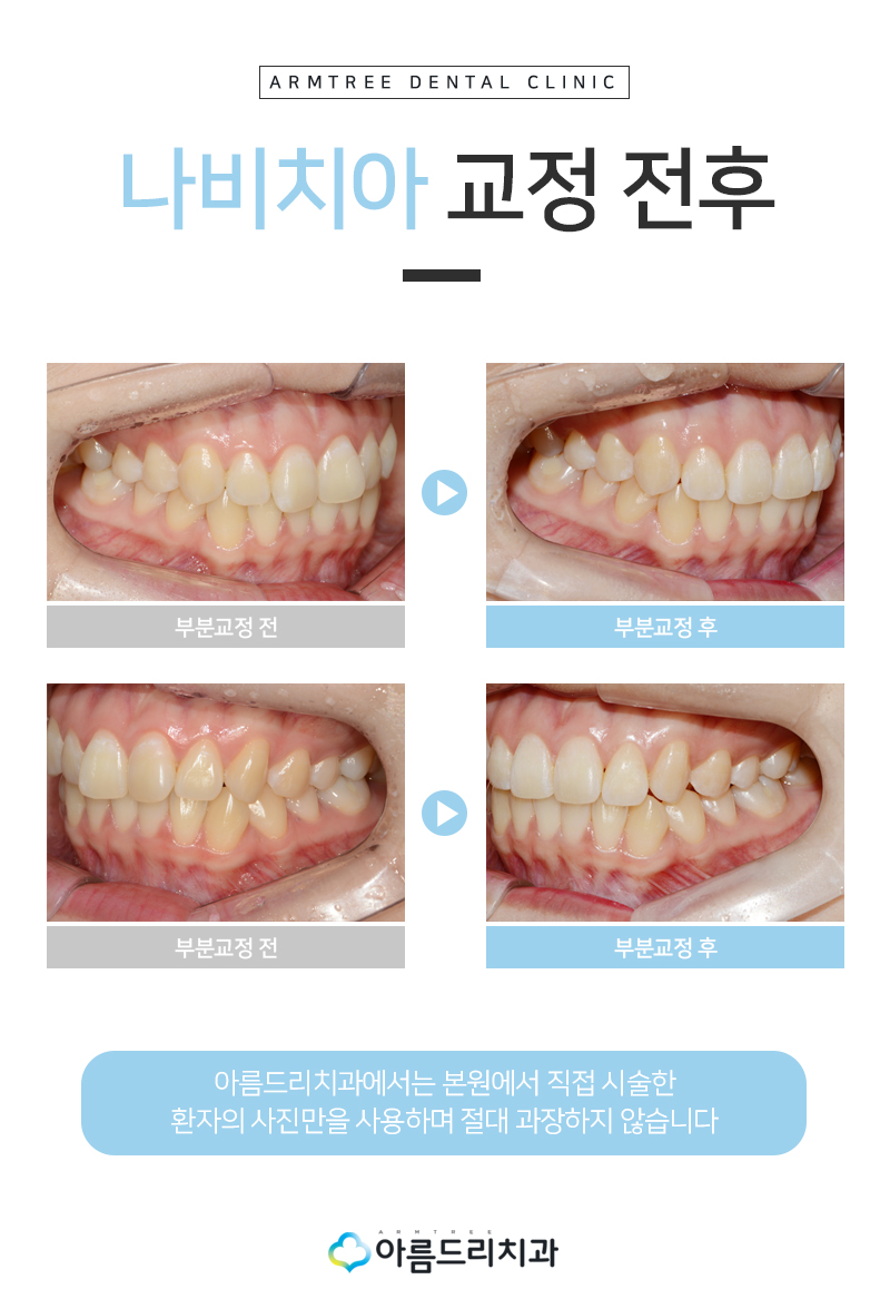 나비치아 교정 앞니 부분교정 후기 관련 이미지 9