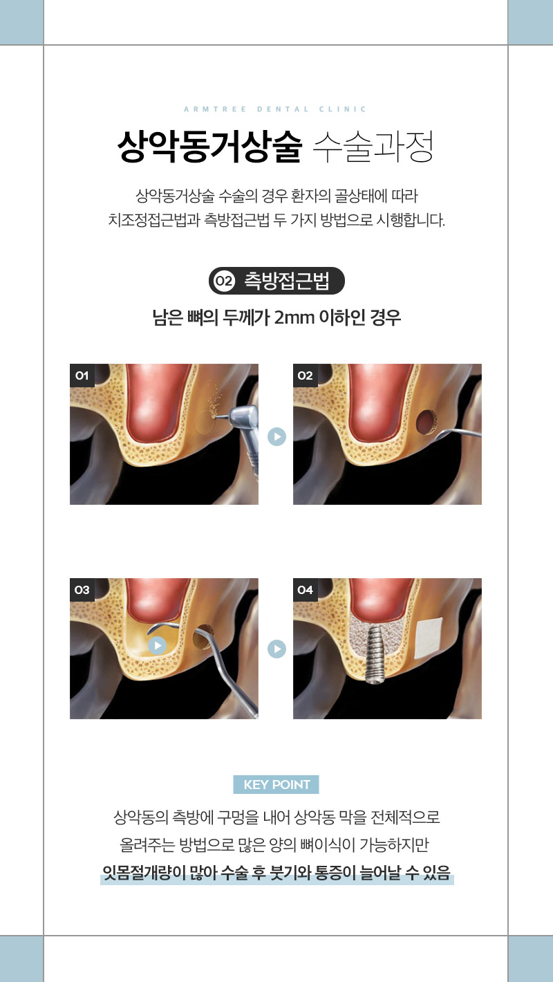 임플란트재수술 상악동거상술 부작용 케이스 진료일기 관련 이미지 7