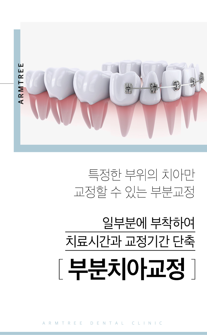 부분교정기간 부담된다면 단기간에 아름드리치과 관련 이미지 2