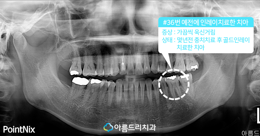 치아우식증 어금니충치 재충치치료 관련 이미지 3