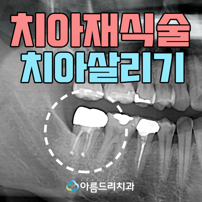 치아재식술 자연치아를지키는 방법 관련 이미지 1
