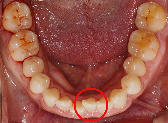 아랫니부분교정 가격 후기 정보후기 관련 이미지 4
