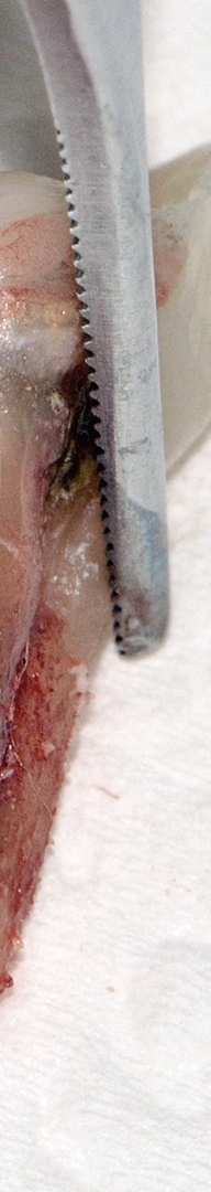 신논현치과 사랑니발치 치과는 신중하게 관련 이미지 10