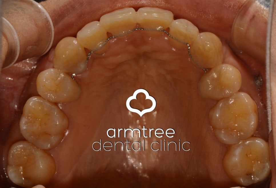이현정원장의 아름다운 당신 시즌 1(4회 박효남 도전자) 돌출입 치아교정 관련 이미지 12