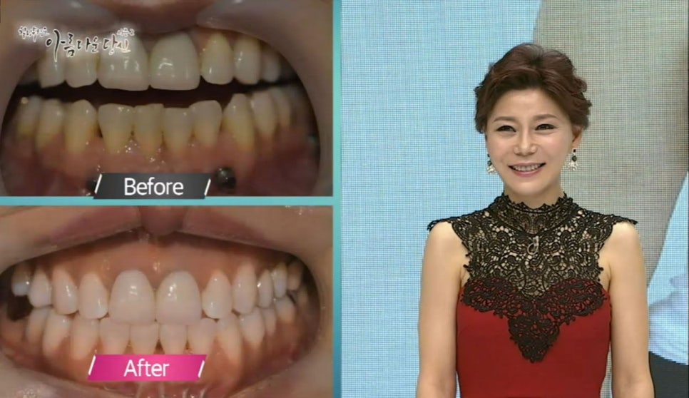 이현정원장의 아름다운 당신 시즌 2(1회 하민주 도전자) 치아 고민 해결 관련 이미지 5
