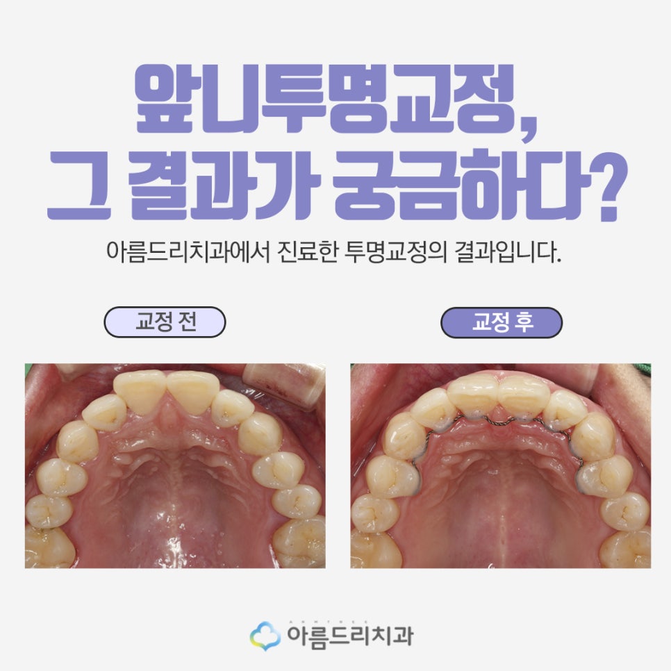 앞니투명교정 전후 아름드리치과 관련 이미지 4