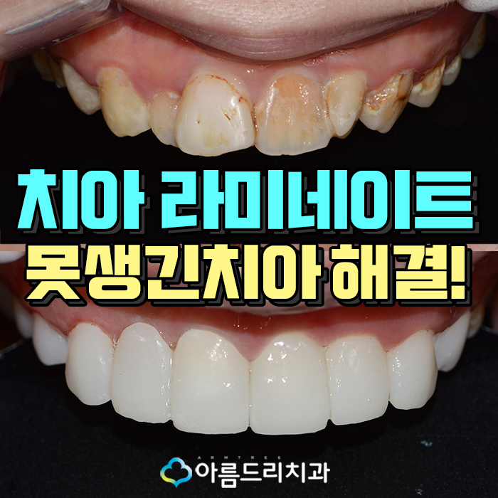 못생긴 앞니 치아라미네이트로 빠르게 관련 이미지 1