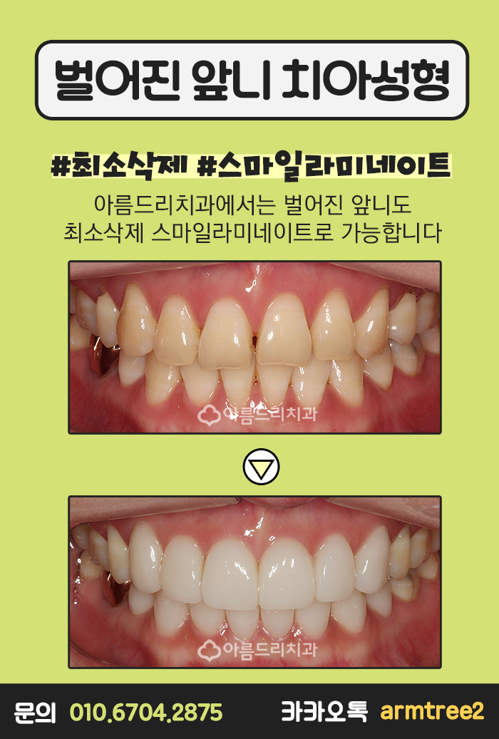 치아벌어짐 치아교정사랑니 아름드리 관련 이미지 7