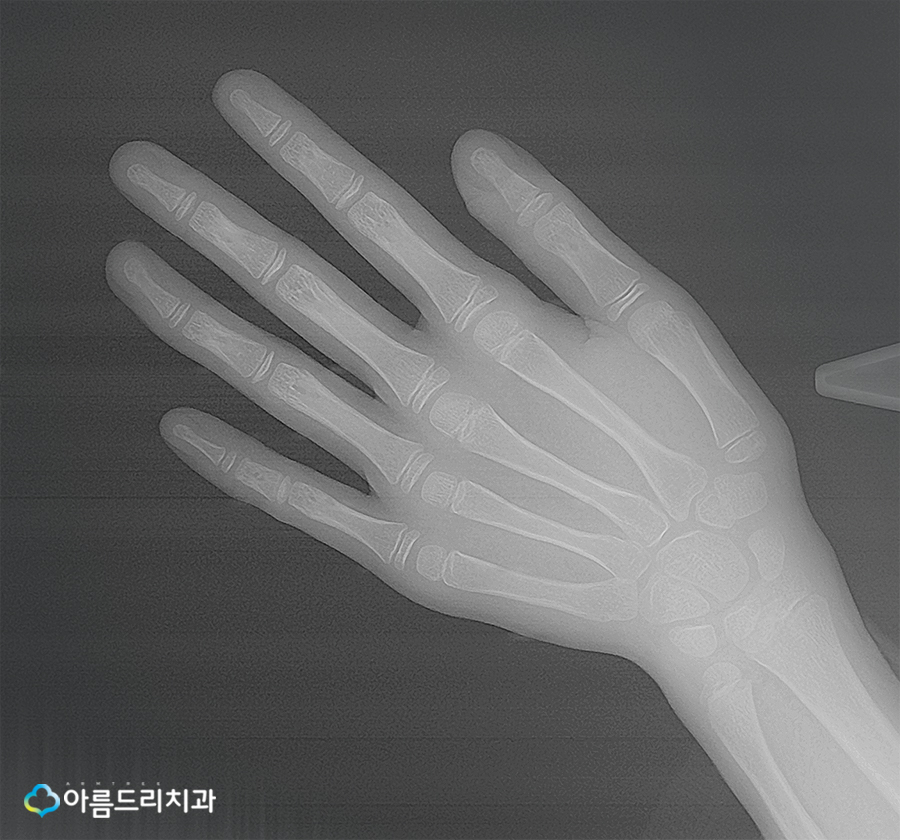 어린이치아교정 부정교합 성장판 검사 관련 이미지 14