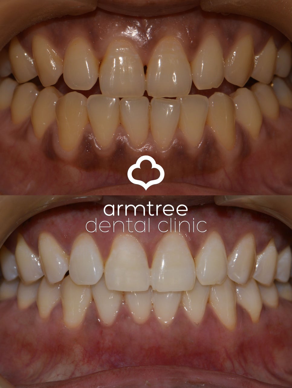 이현정원장의 아름다운 당신 시즌 2 (4회 김양경 도전자) 잇몸미백과 치아미백 관련 이미지 7