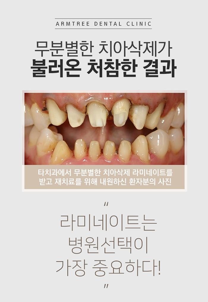 라미네이트교정 더이상 속지마 관련 이미지 2