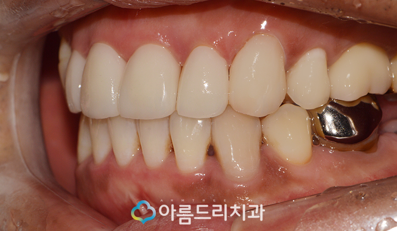 앞니 블랙트라이앵글 치아 이성형으로 해결 관련 이미지 12