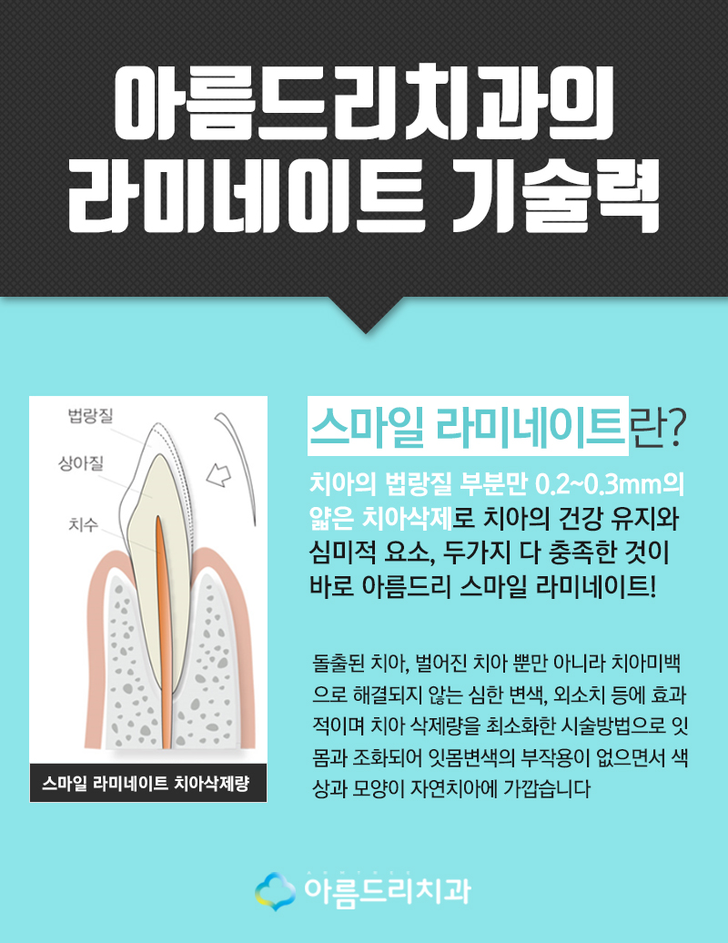 최소삭제 라미네이트 스마일라미네이트 관련 이미지 3