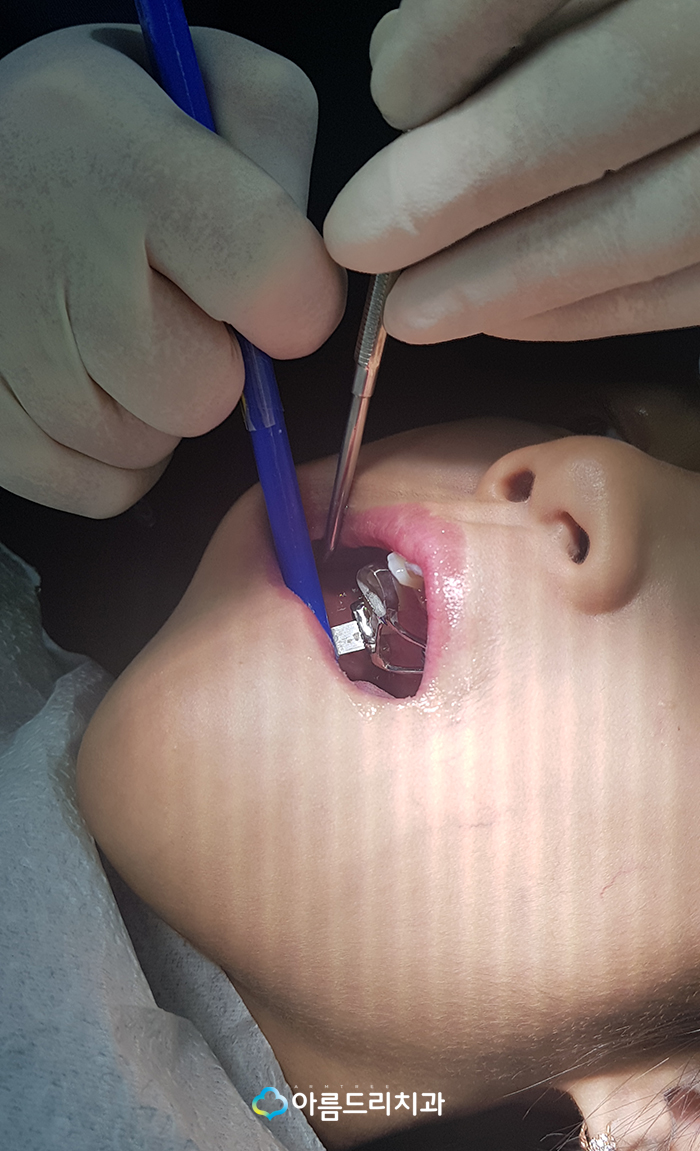 어린이 부정교합교정 RPE 악궁확장장치 관련 이미지 9