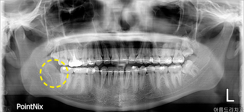 매복사랑니발치 후기 비용 아름드리치과 관련 이미지 5