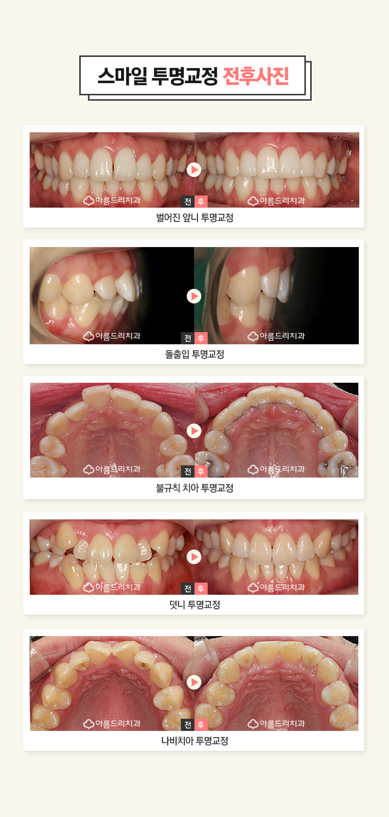 돌출입투명교정 깐깐하게 따지자 관련 이미지 6