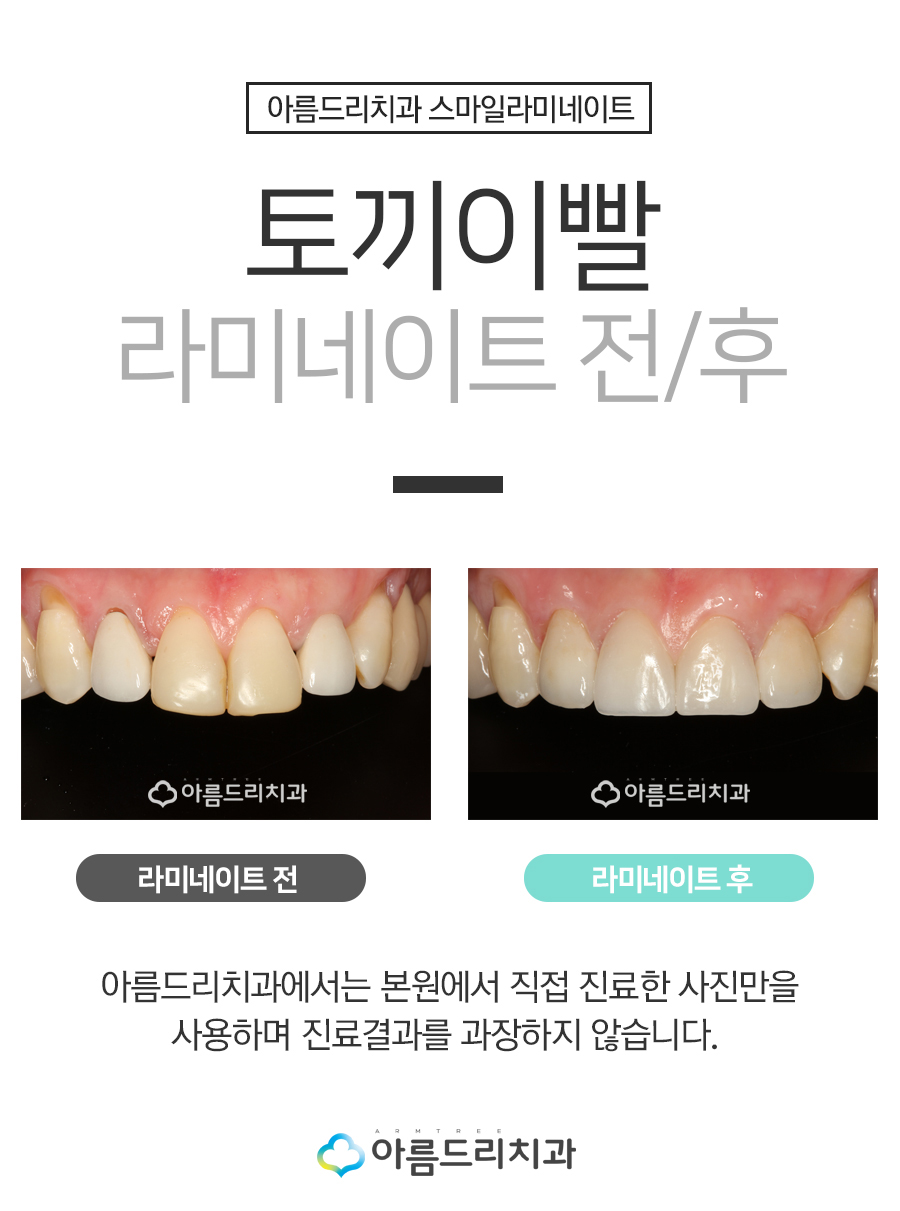 토끼이빨라미네이트 입툭튀 정답은 관련 이미지 6