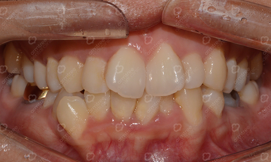 앞니부분교정 꼼꼼하고 예리하게 관련 이미지 2