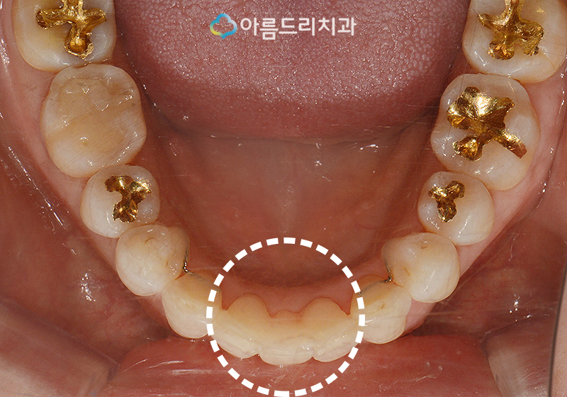 앞니브릿지 치과 치료후기 메릴랜드브릿지 관련 이미지 8