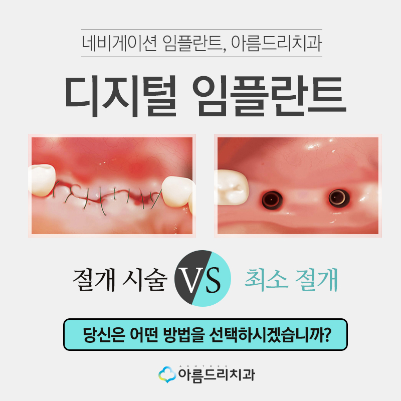 컴퓨터분석임플란트 디지털임플란트 왜? 관련 이미지 2
