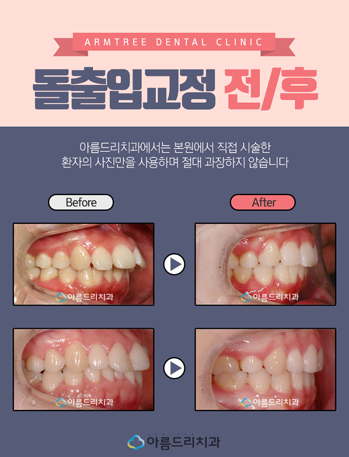 입툭튀교정 돌출입치아교정전후 실화냐? 관련 이미지 6