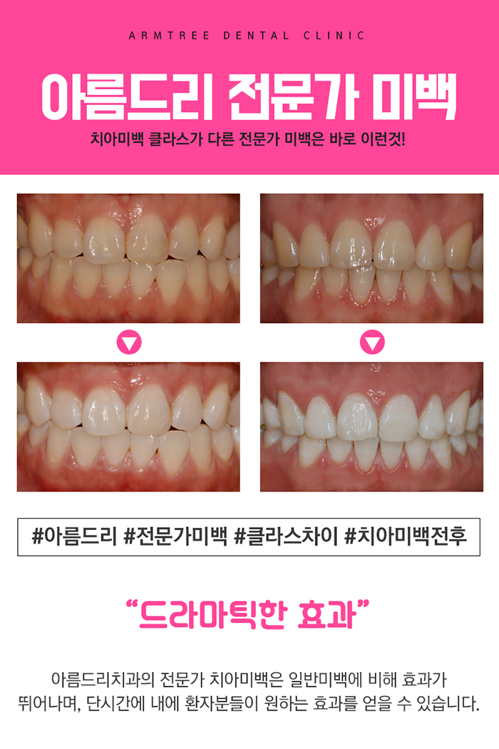 강남역 치아미백 연예인 인증한곳 관련 이미지 4