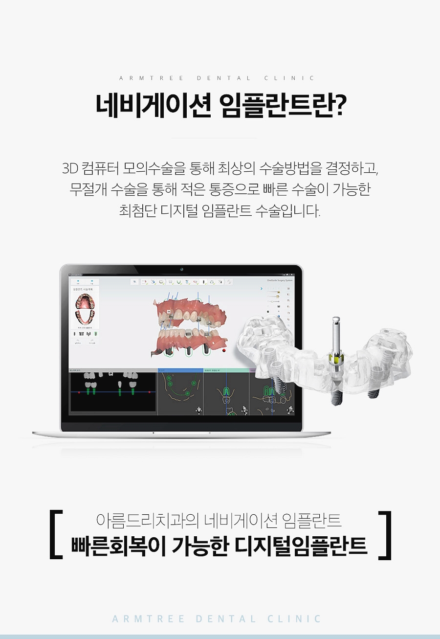 네비게이션임플란트 꼼꼼히 따져보면 관련 이미지 3