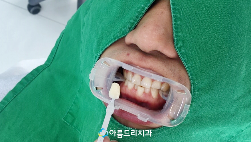 이빨미백 연예인치아미백 누런이 탈출 관련 이미지 5